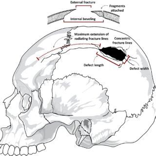 Exploring the Influence of Cranial Trauma on Dream Patterns