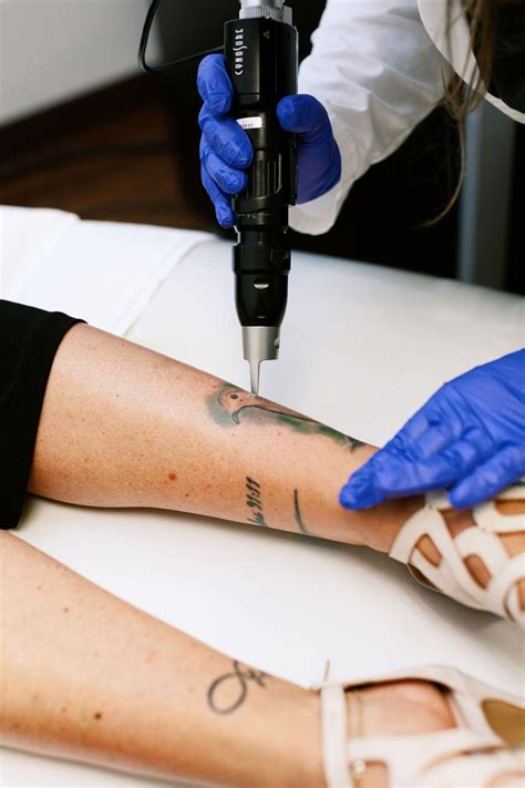 Exploring the Influential Factors in Tattoo Removal Process