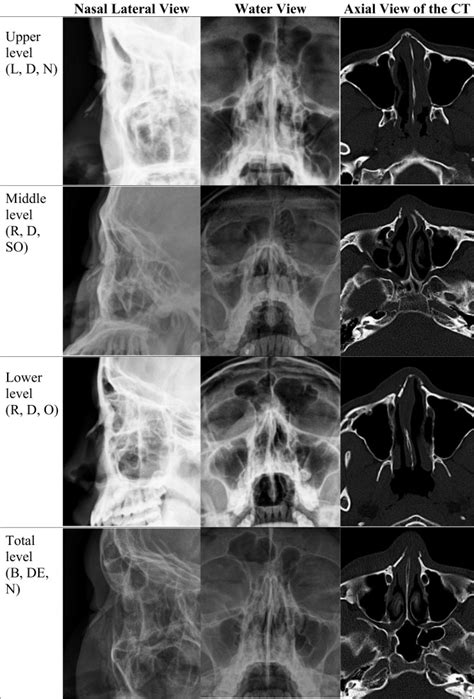 Exploring the Possible Meanings of a Dream Involving the Fracture of Another Individual's Nasal Structure