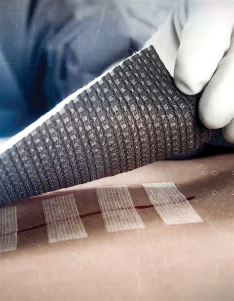 Exploring the Power of Silver Dressings in Wound Healing