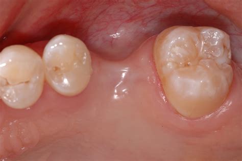 Exploring the Psychological Analyses of Missing Molar Teeth