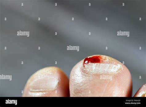 Exploring the Psychological Impact of Dreaming About Bleeding Toes