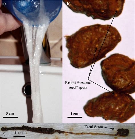 Exploring the Psychological Significance of Worms in Fecal Matter