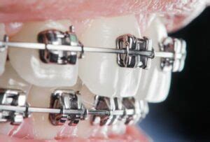 Exploring the Purpose of Orthodontic Treatment: Dispelling Misconceptions