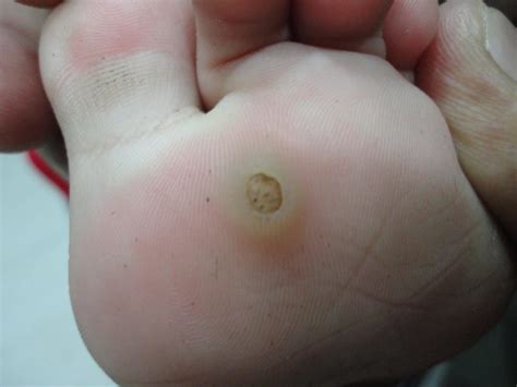 Exploring the Unusual Phenomenon of Warts Appearing on the Limb