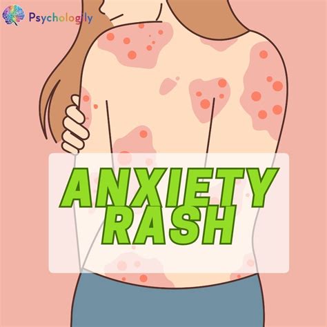 Exploring the connection between stress and experiencing rashes