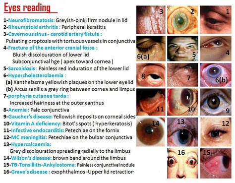 Eye Disorders and Thread-Like Symptoms: An Overview of Medical Conditions