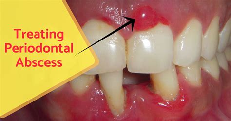 Finding Relief: Approaches to Addressing Mouth Abscess