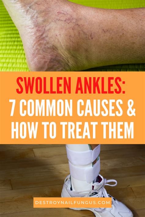 Finding Relief: Effective Treatment Options for Enlarged Ankles