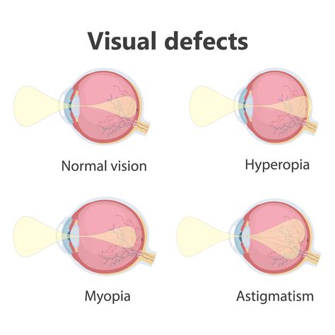 Finding the Perfect Fit: Selecting the Ideal Type of Vision Correcting Lenses for Your Eyes