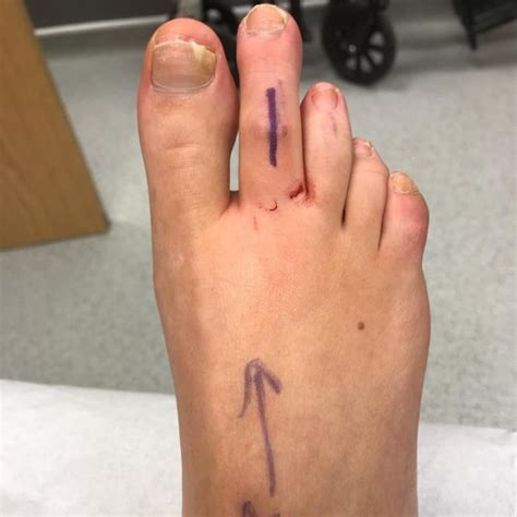 Finding the Right Surgeon for Enhancing Your Toes: Tips and Considerations