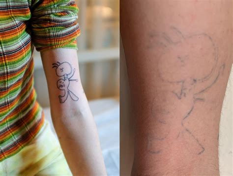 Flecking Away: Tattoo Fading as an Apt Metaphor of Life's Transience