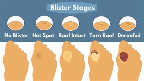 From Irritation to Blisters: The Progression of Symptoms