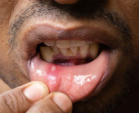 From Minor Irritations to Major Disruptions: Exploring the Various Forms of Oral Ulcers