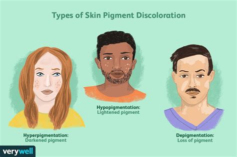 Genetic Factors: Is Your DNA Responsible for Skin Discoloration?