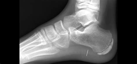 Glass Fragments Lodged in Leg: Interpretation and Significance