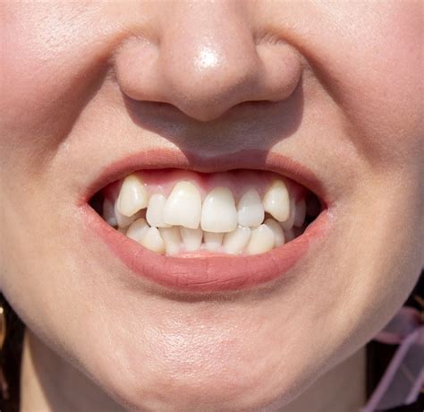 How Misaligned Teeth Impact Your Overall Appearance