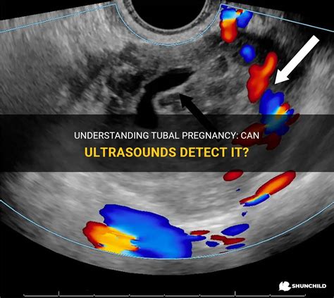 How Ultrasound Can Detect Multiple Pregnancies