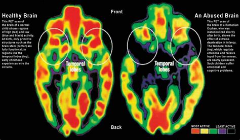 Impact of Childhood Trauma and Neglect on Dream Patterns