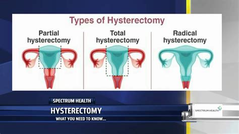 Impact of Hysterectomy on Menstruation