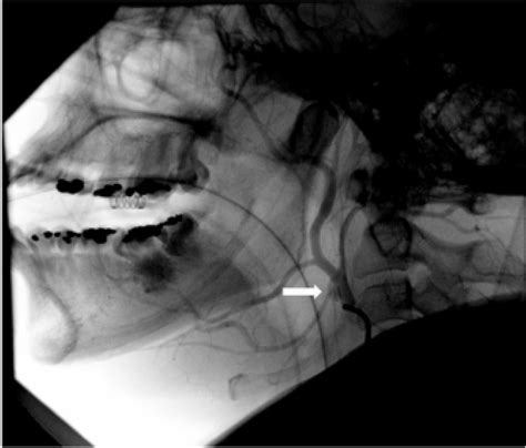 Important Factors to Consider Before Making the Decision to Undergo Tonsillectomy