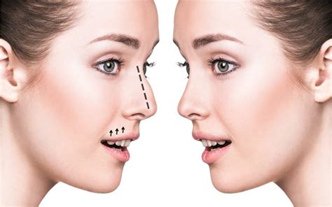 Improve Your Look with Rhinoplasty Procedure