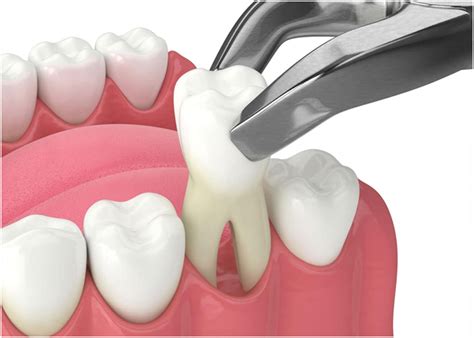 Insightful Strategies for Analyzing and Decoding Tooth Removal Nightmares