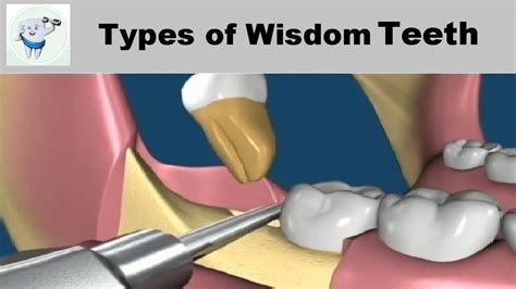 Insights for comprehending and applying dreams related to the removal of wisdom teeth