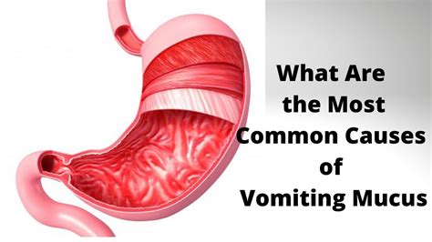 Insights from Experts: Analyzing Vomiting Mucus Dreams