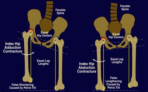 Interpretations of Leg Length Discrepancy in Various Cultures: Superstitions and Taboos