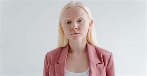 Interpreting the Symbolism of Encountering an Albino in Your Dream