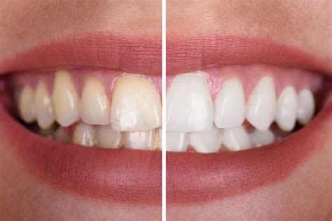 Is Professional Teeth Whitening Worth it?