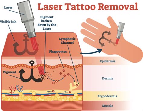 Laser Tattoo Removal: How Does It Work?