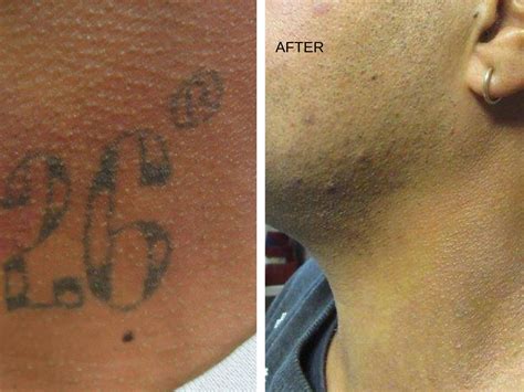 Laser Tattoo Removal: Important Considerations Before Taking the Plunge