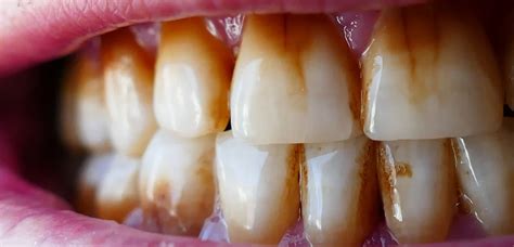 Lifestyle Habits that Contribute to Teeth Staining