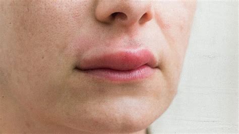 Lip Injuries: Treating and Preventing Swelling