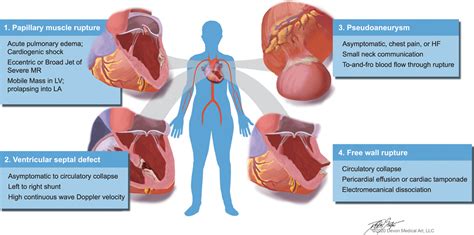 Long-Term Effects and Lifestyle Changes Following Cardiac Surgery