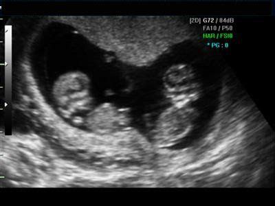 Magnificent Miracles: Discovering Twin Pregnancy through Ultrasound