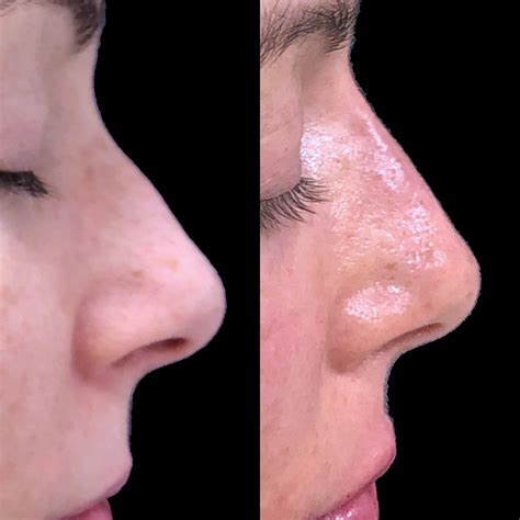 Managing Expectations: Realistic Goals and Results in Nose Reshaping