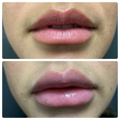 Managing and Minimizing Side Effects of Lip Enhancements