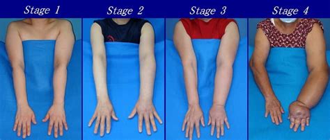 Medical Conditions Related to Swelling in the Upper Extremities