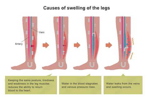 Medical Conditions That Contribute to Edema in the Lower Extremities