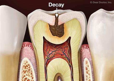 Medical Conditions that May Trigger Dreams of Decayed Teeth