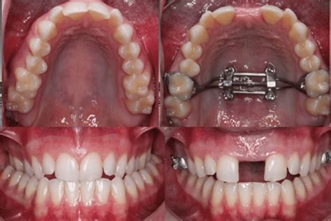 Methods of Deciphering the Expansion of Teeth in Fantasies