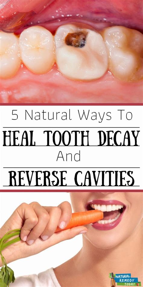 Natural Remedies for Decayed Teeth: Alternative Approaches to Dental Care