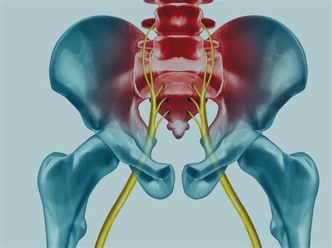 Nerve Compression and Sciatica