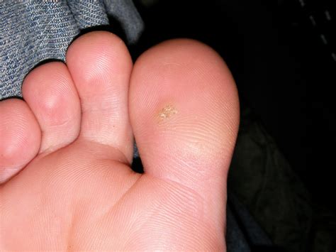 Next Steps to Take after Experiencing a Wart-Like Growth on Your Foot