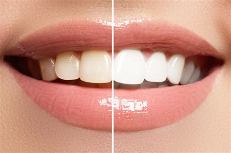 Options for Professionally Whitening Discolored Teeth