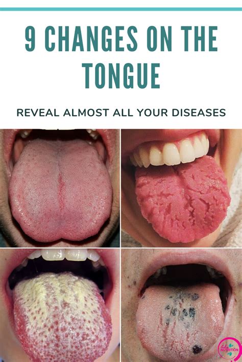 Oral Conditions: Tongue-Related Issues to Be Aware Of