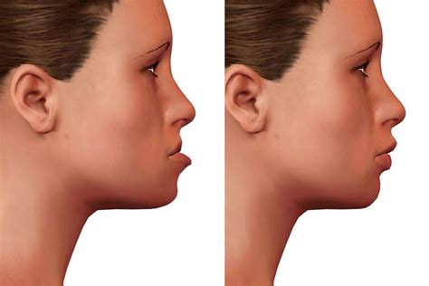 Orthognathic Surgery: Attain a Harmonized and Ideal Tooth Spacing